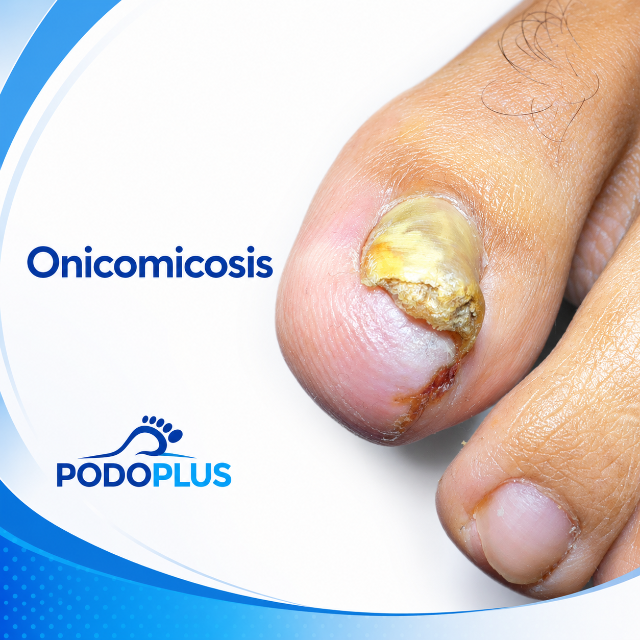 Onicomicosis