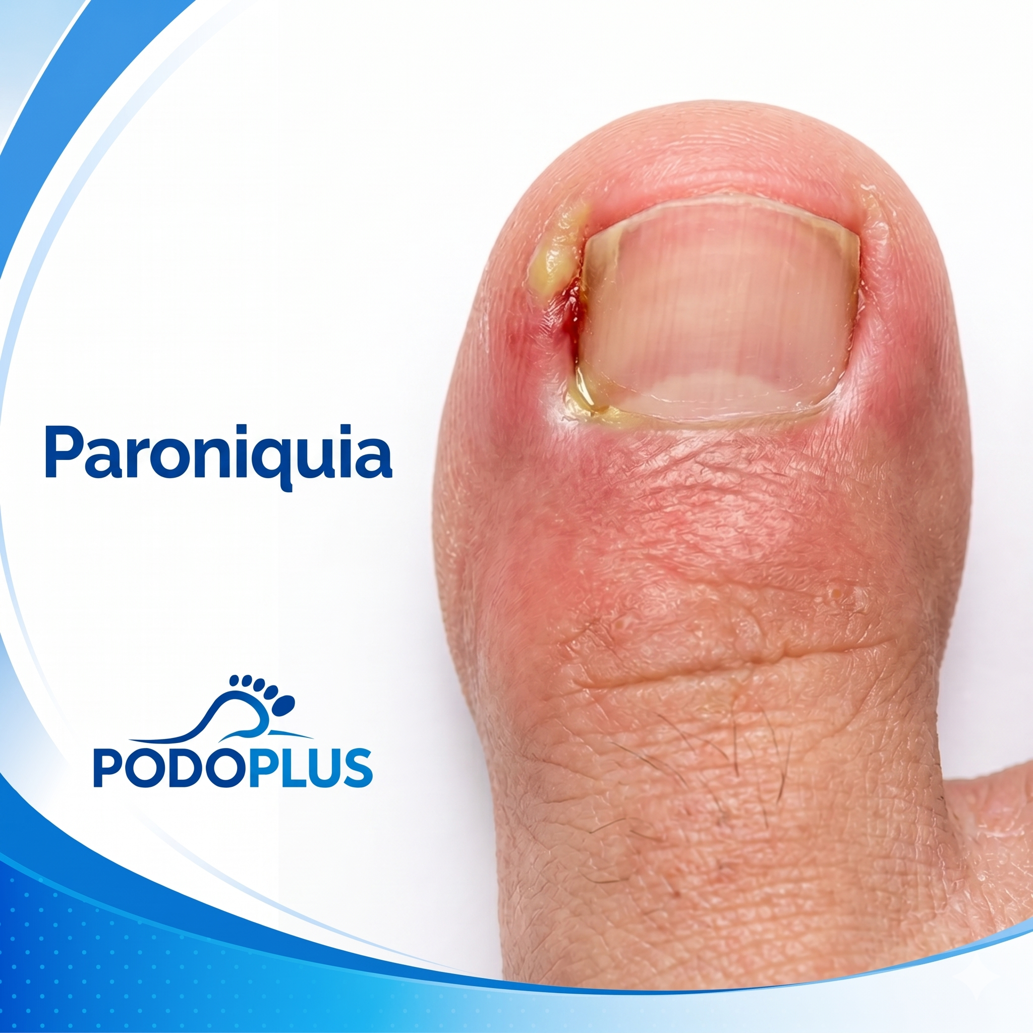 Paroniquia